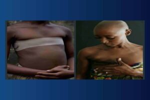 Breast ironing not to attract the men